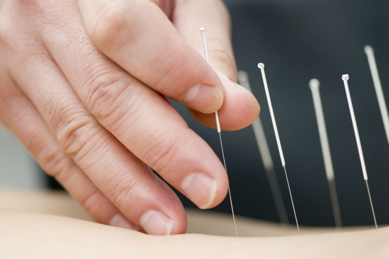 close up photo of dry needling